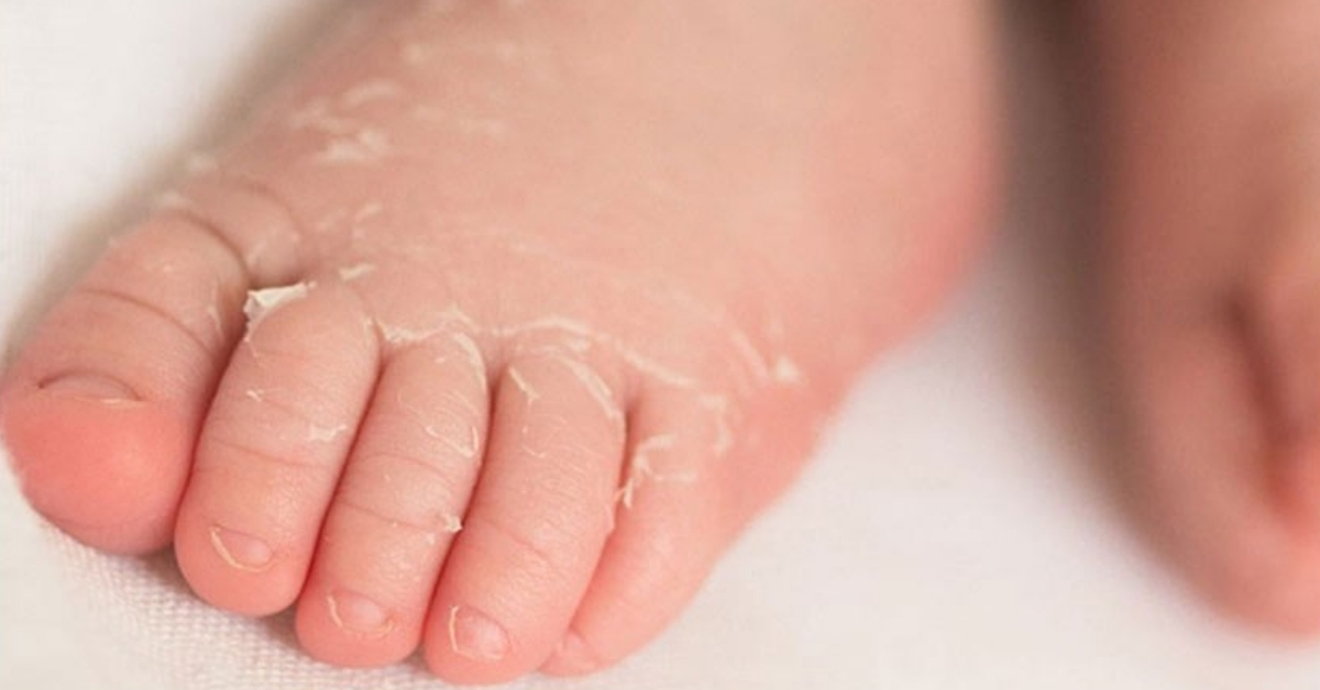 Vì Sao Da Trẻ Sơ Sinh Dễ Bị Khô? Nguyên Nhân Và Cách Chăm Sóc Mẹ Cần Biết